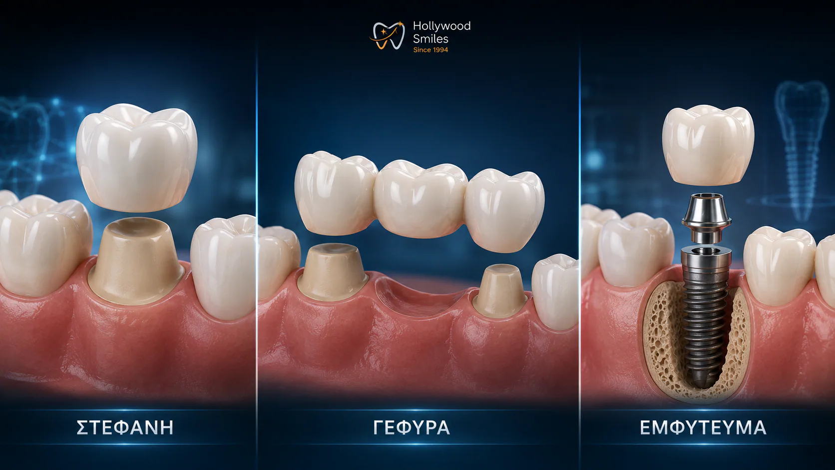 Crown, bridge or implant: what are the main differences?